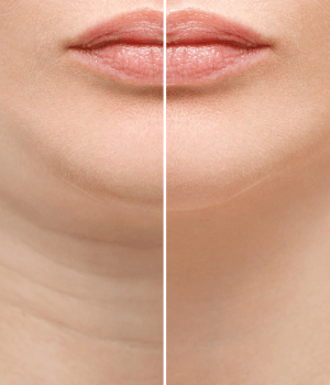 lipo de papada clinica anastasia-min